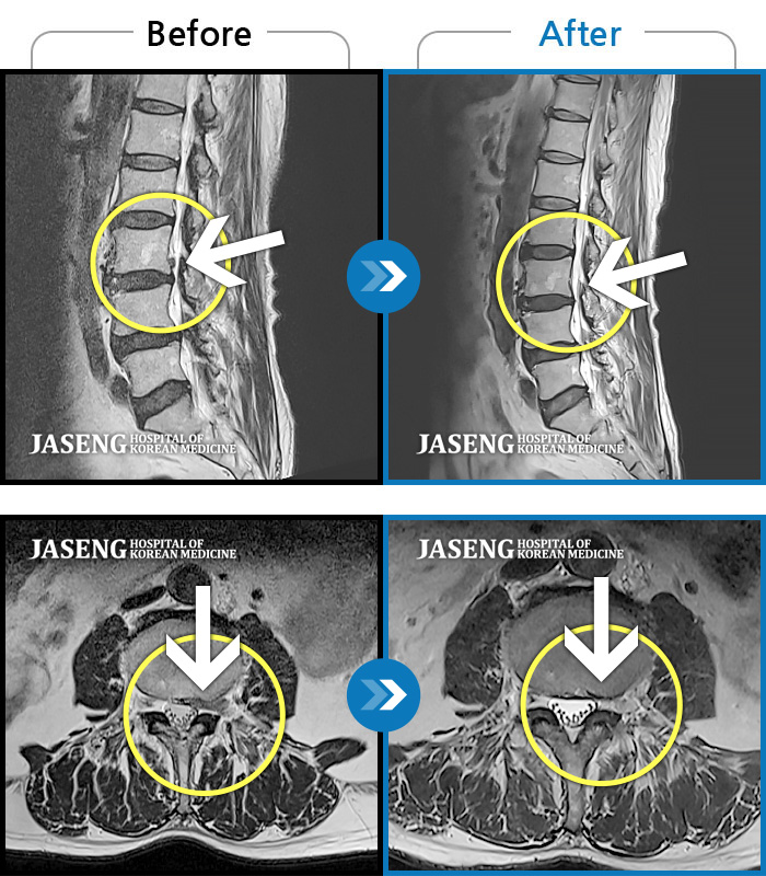 자생한방병원 치료사례 MRI로 보는 치료결과-왼쪽 허리 엉덩이 다리까지 하루종일 저렸어요.