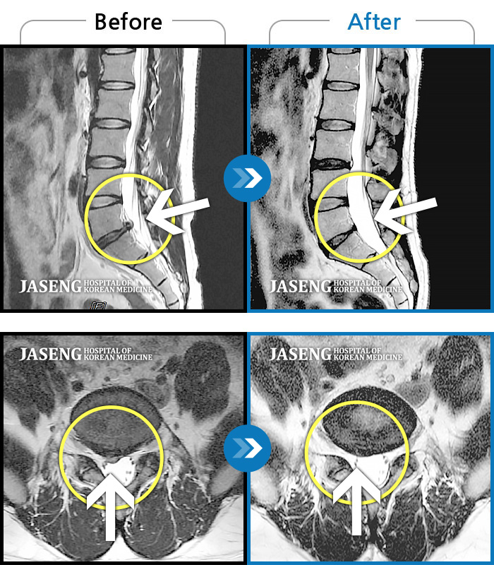 자생한방병원 치료사례 MRI로 보는 치료결과-척추전방전위증과 디스크로 허리가 많이 아프고 오래 앉지 못했습니다.