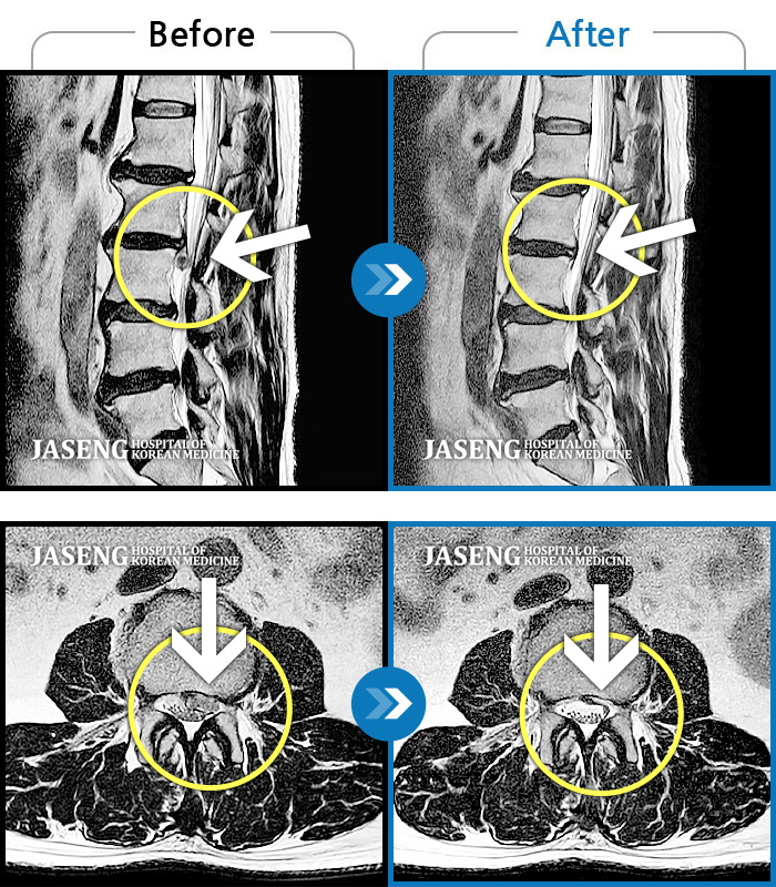 자생한방병원 치료사례 MRI로 보는 치료결과-허리 및 좌측 다리통증이 심해서 밤에 잠을 못자요.