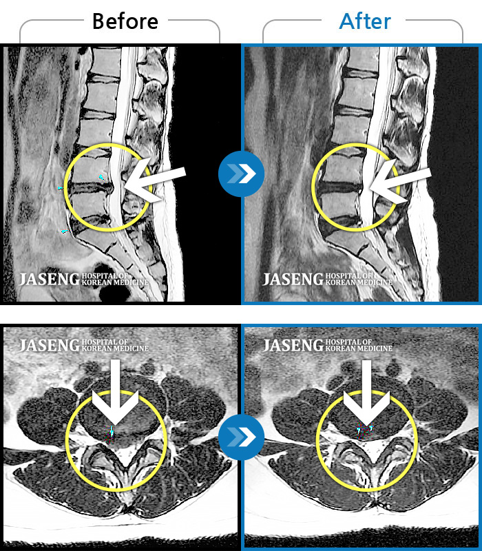자생한방병원 치료사례 MRI로 보는 치료결과-허리, 양쪽 엉치 부터 종아리까지 저리고 아픈 증상이 있었다. 