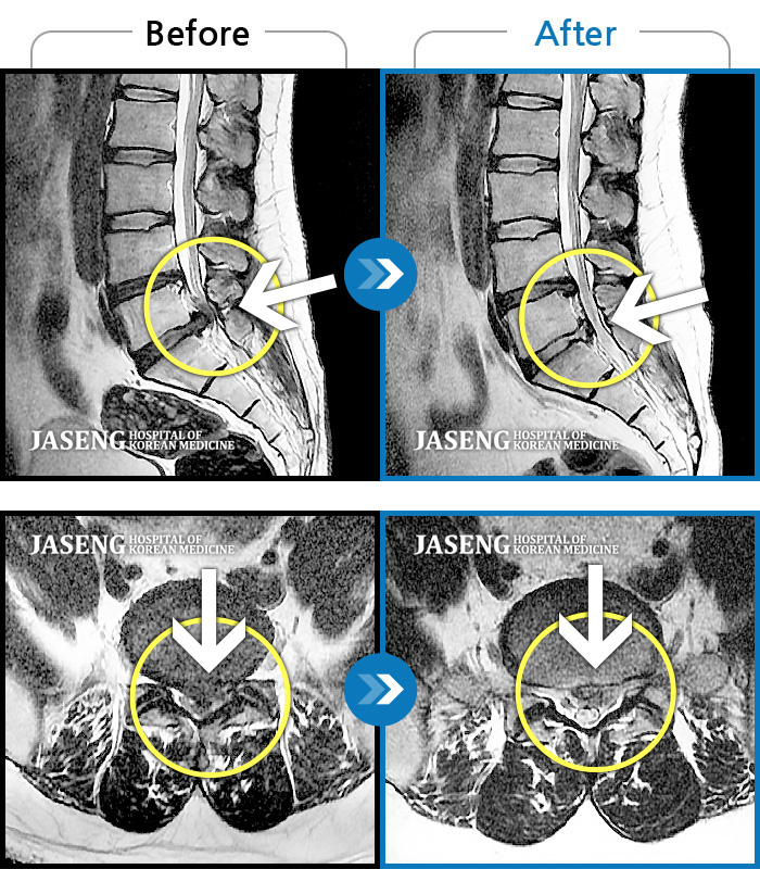 자생한방병원 치료사례 MRI로 보는 치료결과-일상생활 불가능한 통증으로 본원 내원