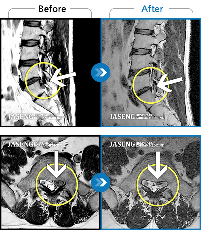 자생한방병원 치료사례 MRI로 보는 치료결과-해외파견근무 중 디스크 탈출로 보행이 불가능한 상태