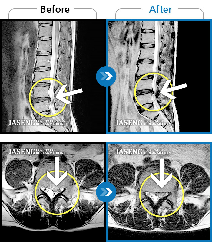자생한방병원 치료사례 MRI로 보는 치료결과-재발한 허리디스크, 계속되는 요통 및 하지 방사통으로 내원