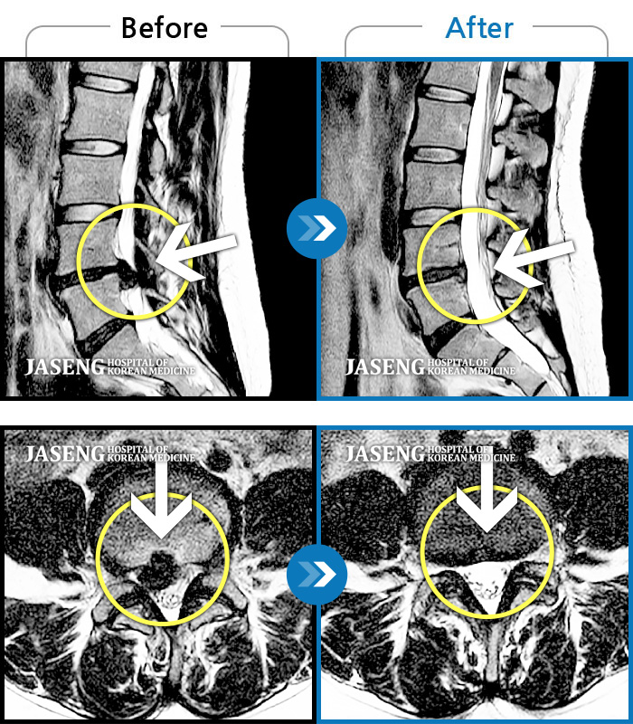 자생한방병원 치료사례 MRI로 보는 치료결과-허리 골반이 아프고 오른쪽 종아리가 저리고 쑤시듯 아파요.