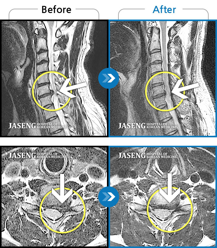 자생한방병원 치료사례 MRI로 보는 치료결과-갑자기 발생한 목 통증과 좌측 손저림으로 고통스러운 상태