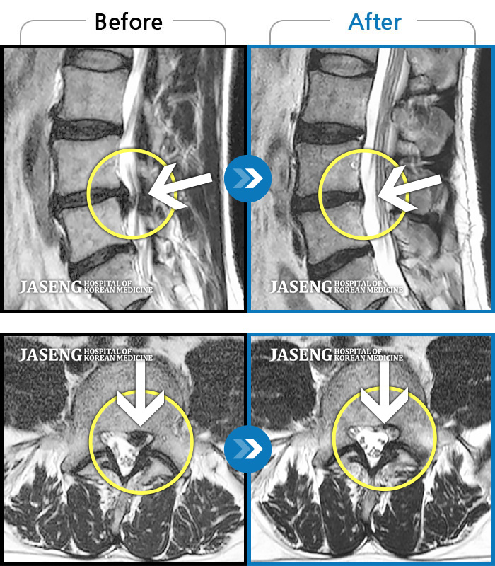 자생한방병원 치료사례 MRI로 보는 치료결과-좌측 종아리 터질듯한 통증으로 몇 주간 잠도 못 잘 정도로 많이 힘들었어요