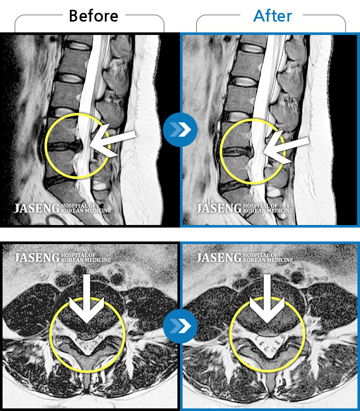 자생한방병원 치료사례 MRI로 보는 치료결과-허리 통증이 심하고,  양측다리 하지 쪽으로 땡기고 저려요.