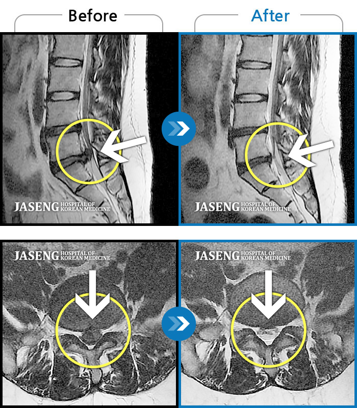 자생한방병원 치료사례 MRI로 보는 치료결과-처음 내원 시 허리통증 및 좌측 다리저림으로 앉아있는게 어렵고, 정상적인 보행이 어려운 상태였습니다. 