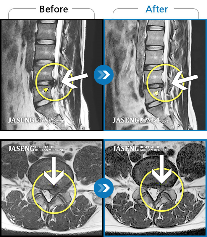 자생한방병원 치료사례 MRI로 보는 치료결과-허리 통증으로 누워있는 자세를 제외하고 모든 자세에서 통증이 심화