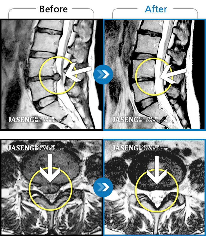 자생한방병원 치료사례 MRI로 보는 치료결과-운전 후 갑자기 통증과 다리저림이 심해져 거동이 안될 정도였습니다.