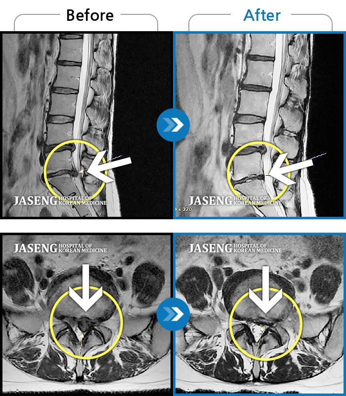 자생한방병원 치료사례 MRI로 보는 치료결과-양측 하요추부 통증과 우측 하지 저림