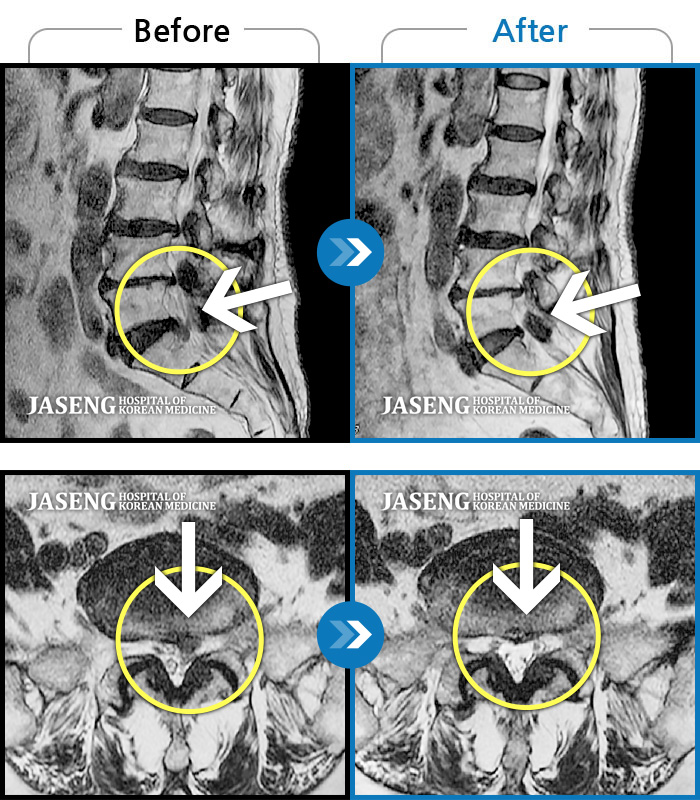 자생한방병원 치료사례 MRI로 보는 치료결과-처음 내원 시 요통, 좌측 하지 방사통으로 인해 통증이 심했습니다.
