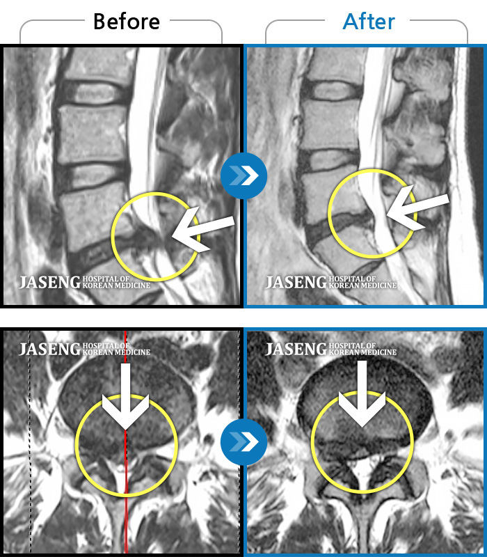 자생한방병원 치료사례 MRI로 보는 치료결과-허리가 아프고 우측 다리에 힘이 없고 방사통이 심해 걸을 수가 없었다.