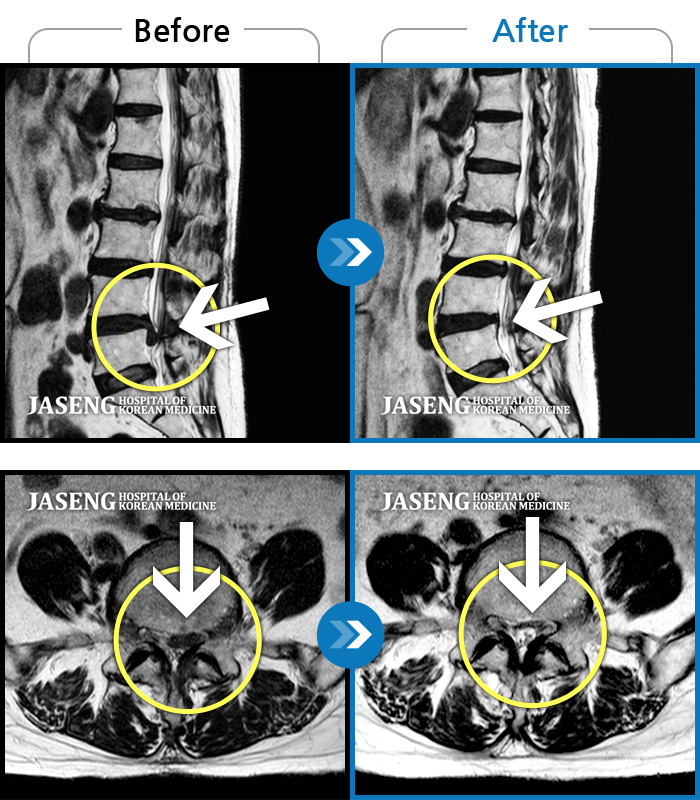 자생한방병원 치료사례 MRI로 보는 치료결과-가만히 누워있어도 다리가 저리고 허리에 조금 힘이 들어가도 아파서 꼼짝 못했다