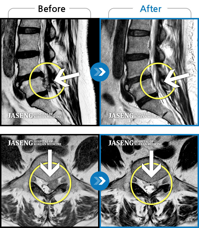 자생한방병원 치료사례 MRI로 보는 치료결과-욕실 청소중 바닥에 떨어진걸 줍다가 엄청난 통증이 으악!! 허벅지 뒤쪽으로 줄이 탕! 하고 끊어지는 느낌과 함께 몸을 꼼짝 못하는 상태