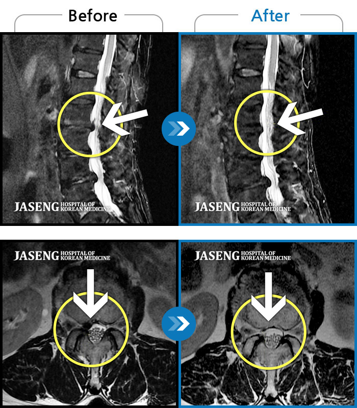 자생한방병원 치료사례 MRI로 보는 치료결과-하요추부 통증과 좌측 하지 저림