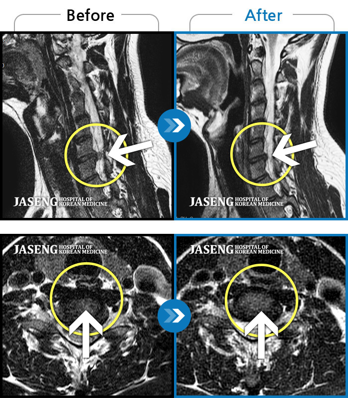 자생한방병원 치료사례 MRI로 보는 치료결과-좌측 손 저림 및 근력 약화로 일상생활이 불가능