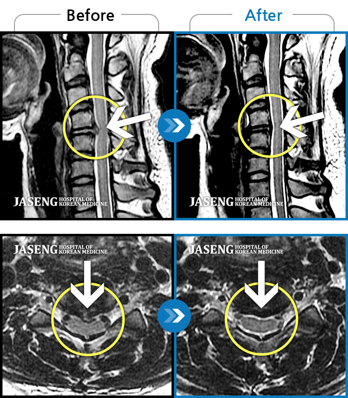 자생한방병원 치료사례 MRI로 보는 치료결과-운동 중 급격하게 발생한 후경부~좌측 어깨 및 좌측 상지 전반적인 저림이 있었다.