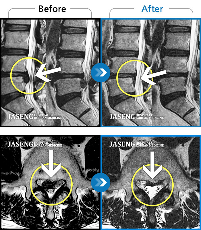 자생한방병원 치료사례 MRI로 보는 치료결과-일상생활 중 발생한 양측 골반, 양측 대퇴~종아리 외측의 극심한 견인통과 비증이 있었다