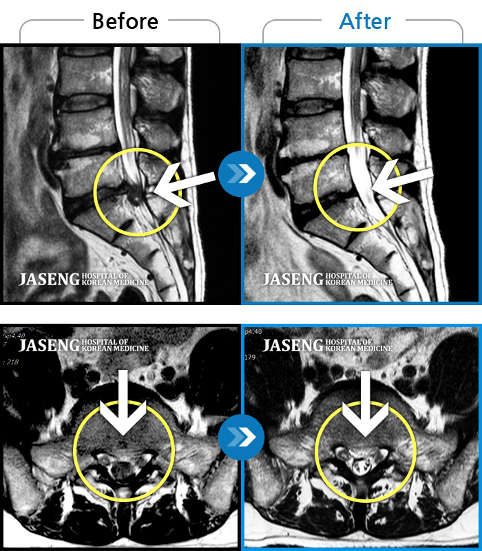 자생한방병원 치료사례 MRI로 보는 치료결과-허리통증 및 우측 다리 통증으로 걷지 못하고 일상생활이 불가능했습니다.