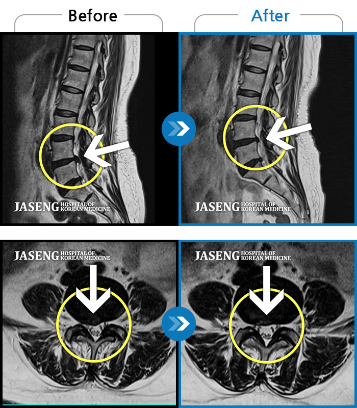 자생한방병원 치료사례 MRI로 보는 치료결과-양측 허리부터 양측 골반까지 당기는 통증, 양측 하지 후면으로 이어지는 통증