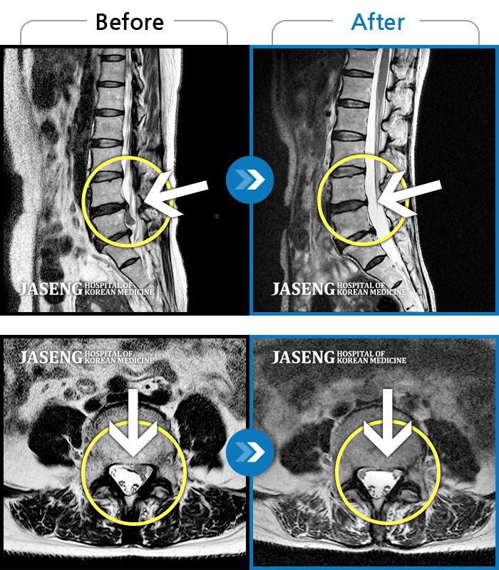 자생한방병원 치료사례 MRI로 보는 치료결과-허리통증이라 왼쪽 발목~발등이 저려요. 엄지발가락에 힘빠지는 느낌, 전기오는 느낌이 있어요.