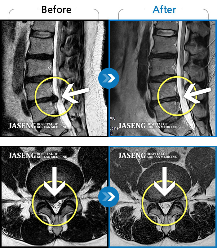 자생한방병원 치료사례 MRI로 보는 치료결과-허리통증 및 왼쪽 다리 통증으로 운전이 불가능했습니다.