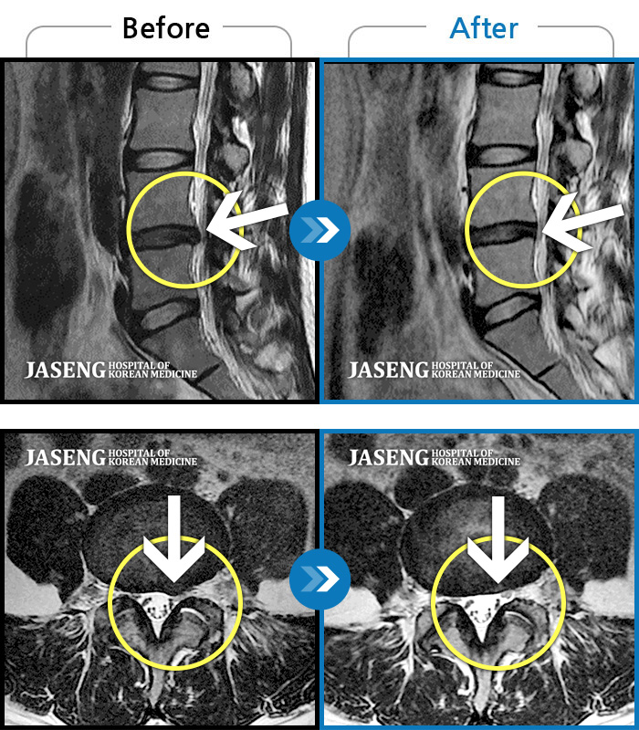 자생한방병원 치료사례 MRI로 보는 치료결과-허리, 엉덩이, 다리의 통증과 저림으로 생활이 불가능