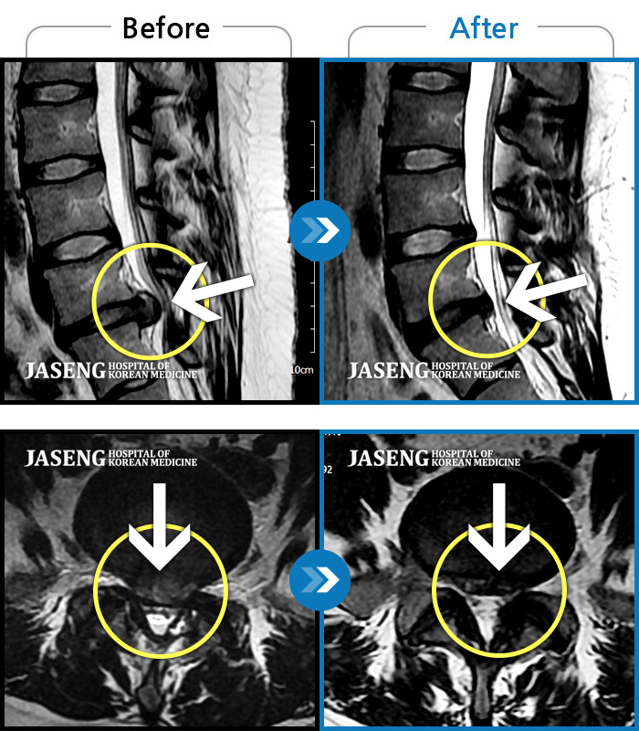 자생한방병원 치료사례 MRI로 보는 치료결과-허리통증으로 보행 불가. 우측 다리의 통증과 저림, 화끈거리는 통증과 차가운 느낌 번갈아 나타남