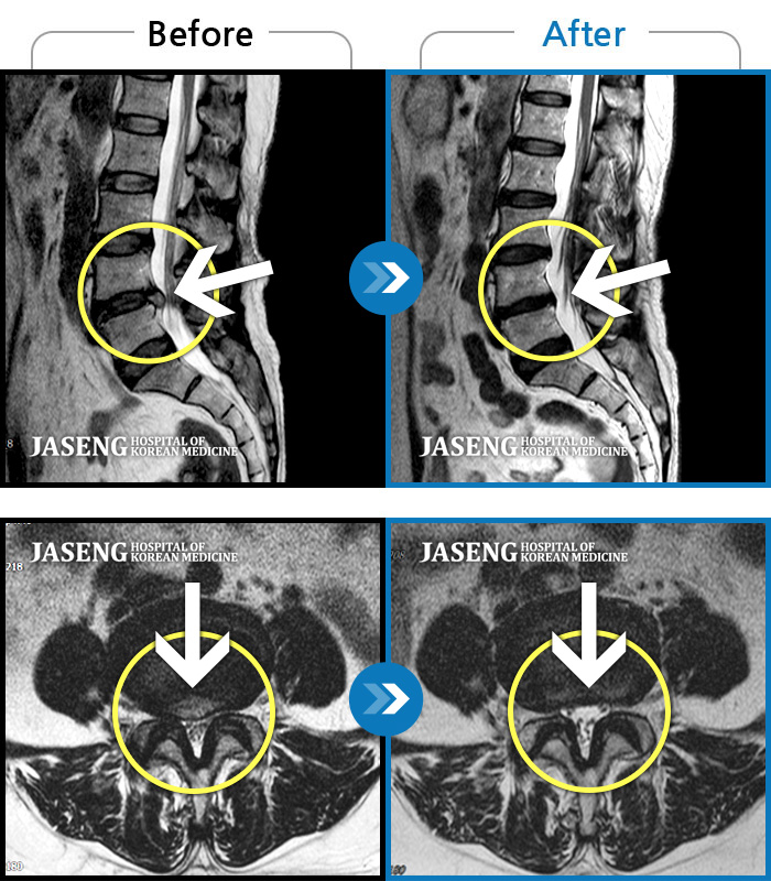 자생한방병원 치료사례 MRI로 보는 치료결과-내원 당시 추간판 탈출 및 척추관 협착증으로 잠자기 어려울 정도의 요통 및 오른쪽 골반~종아리 저림으로 일상생활이 어려우셨던 분입니다. 