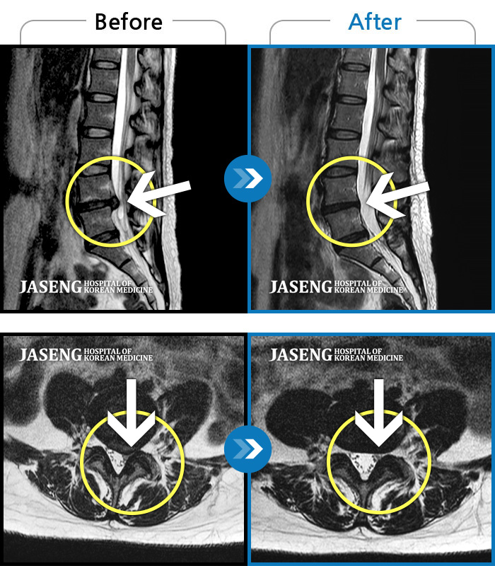 자생한방병원 치료사례 MRI로 보는 치료결과-허리, 다리의 극심한 통증으로 거동이 힘들고 일상생활과 정상적인 업무가 불가능한 상태에서 내원하신 환자분입니다.