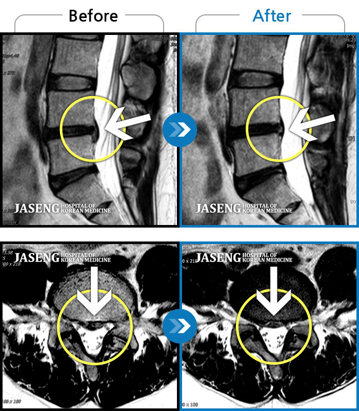 자생한방병원 치료사례 MRI로 보는 치료결과-허리통증이 심해서 숙이기 어렵고 차에서 내리기 힘들었습니다.