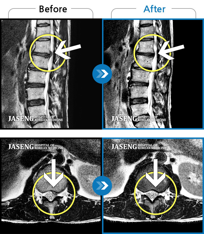 자생한방병원 치료사례 MRI로 보는 치료결과-처음 내원시 허리 통증이 심하여 일상생활에 불편감이 있으신 환자분이셨습니다.