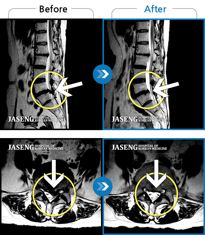 자생한방병원 치료사례 MRI로 보는 치료결과-좌측 둔부, 좌측 다리로 이어지는 통증이 심해 발을 내딛는것이 어려운 상태로 내원하신 환자분입니다.