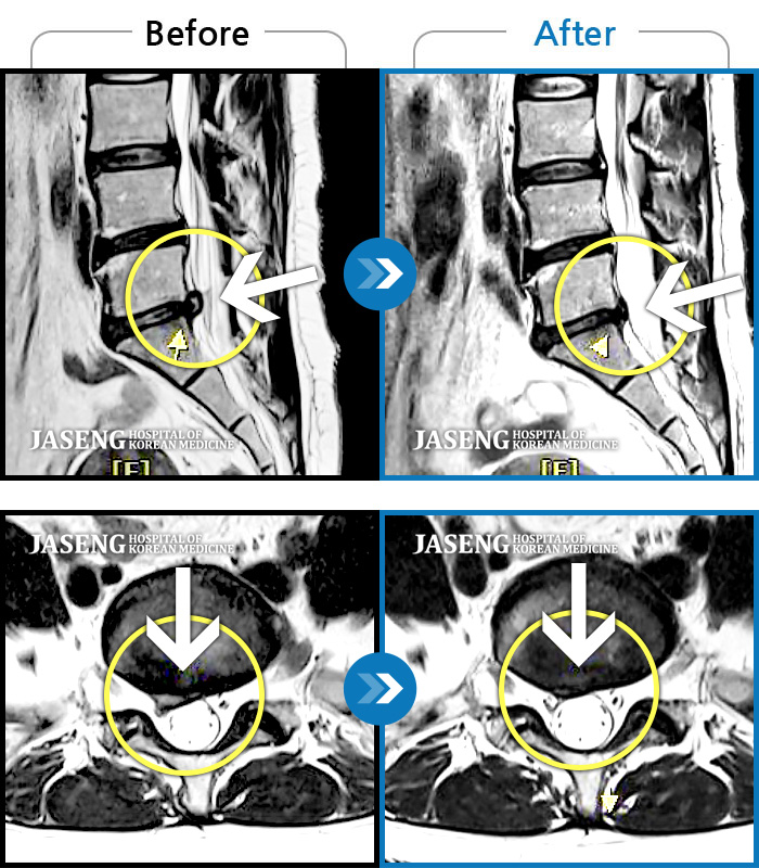 자생한방병원 치료사례 MRI로 보는 치료결과-양측 허리부터 좌측 다리까지 이어지는 저림과 통증으로 걷기 힘들어 내원하였습니다.