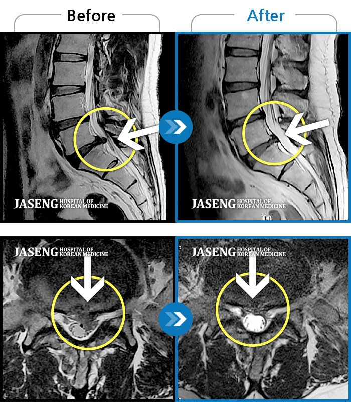 자생한방병원 치료사례 MRI로 보는 치료결과-모든 자세에서 지속적으로 좌측 엉치, 허벅지, 종아리 후면, 외측, 발가락 끝까지 저리고 아프다. 