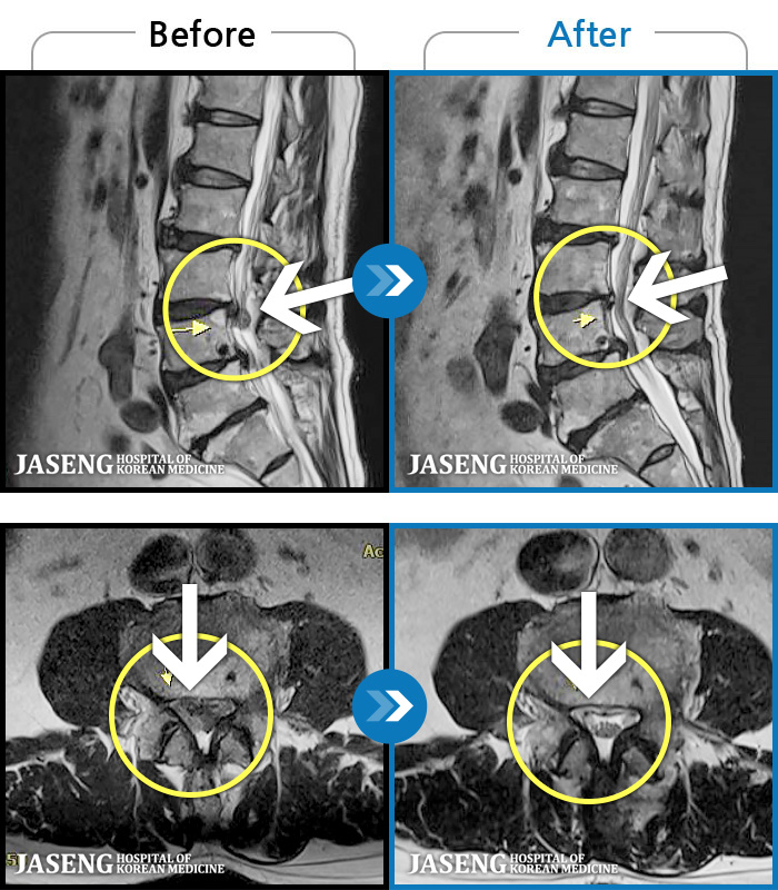 자생한방병원 치료사례 MRI로 보는 치료결과-양측 허리부터 골반까지 묵직한 통증, 우측 다리 방사통이 심하여 내원하셨습니다.