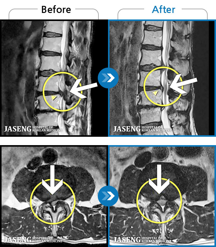 자생한방병원 치료사례 MRI로 보는 치료결과-양측 허리부터 골반 묵직한 통증, 좌측 다리 외측까지 이어지는 당기는 통증으로 내원하셨습니다.