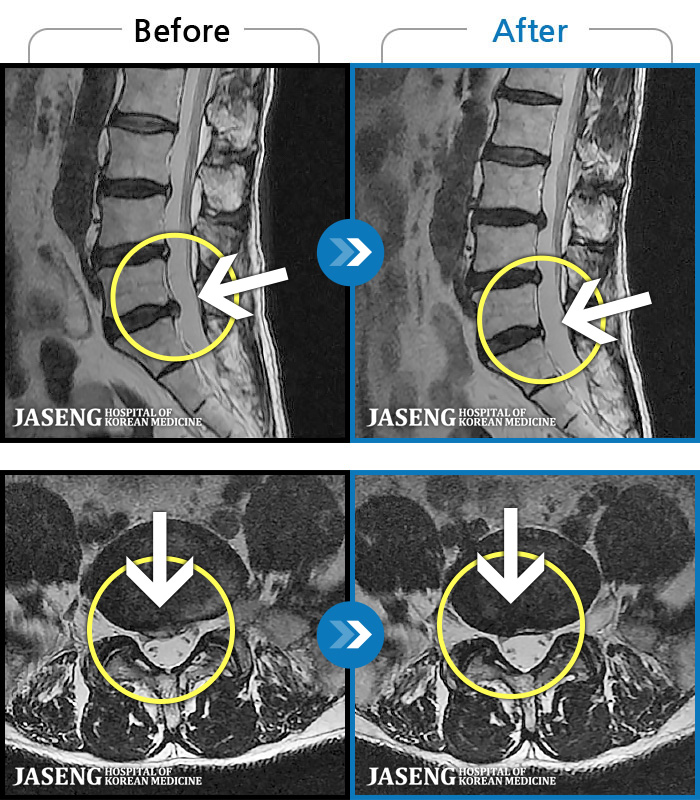 자생한방병원 치료사례 MRI로 보는 치료결과-우측 골반 통증이 심하고 우측 하지로 당김과 저림이 지속되었습니다. 야간통이 심하여 야간 수면 제한이 되는 등 중등도 이상의 통증을 호소하는 상태였습니다.