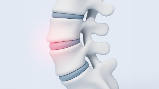 튀어나온 척추 및 자극 시 통증