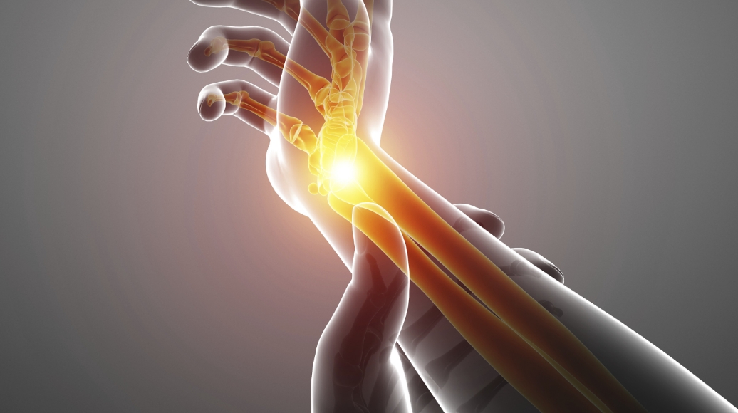 손목 골절, 탈구로 신경 압박