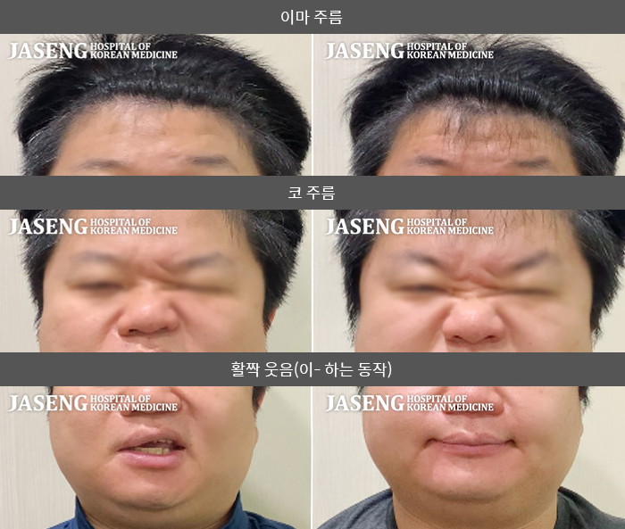 자생한방병원 치료사례 MRI로 보는 치료결과-우측 눈을 감을 수 없고 이마 주름이 지어지지 않으며 우측 구각이 움직이지 않는다.