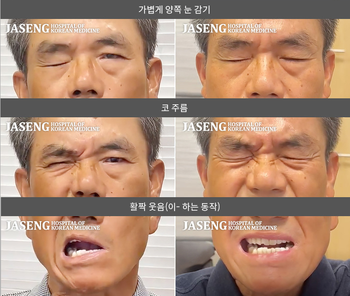 자생한방병원 치료사례 MRI로 보는 치료결과-왼쪽 눈이 잘 안 감기고 왼쪽 안면부 전체가 마비된 느낌이다.