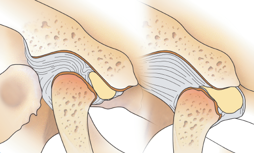 턱 관절염(골관절변형)