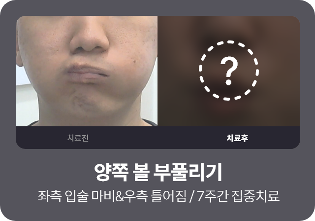 양쪽 볼 부풀리기 , 좌측 입술 마비&우측 틀어짐 / 7주간 집중치료