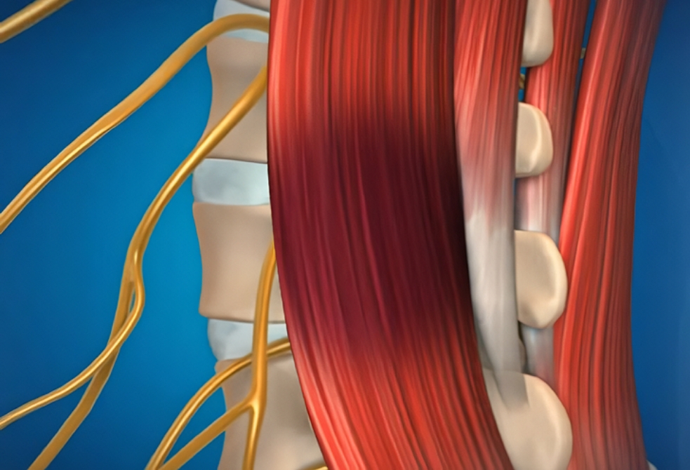 (1~2주 이내) 염증/경증 디스크