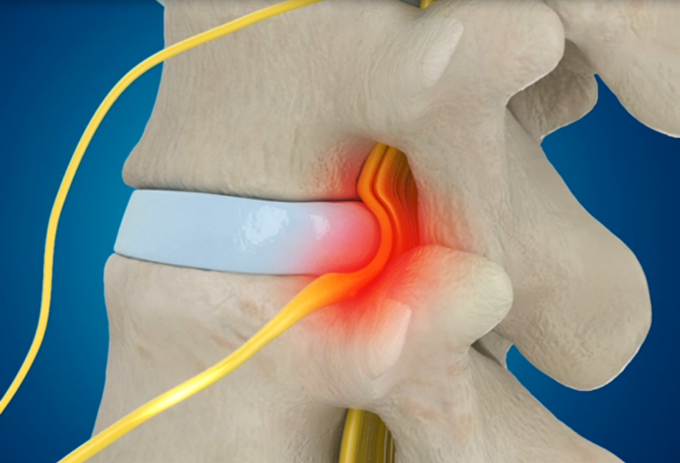 (2~3주이내) 일반 디스크