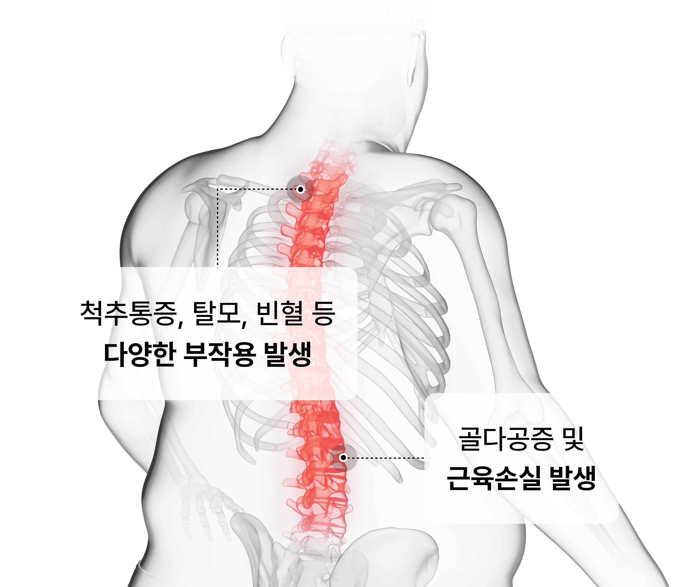 척추통증, 탈모, 빈형 등 다양한 부작용 발생 , 골다공증 및 근육손실 발생